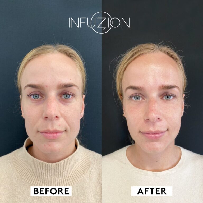 Infuzion System Volymizer voor en na resultaat bij Le Sa Lon Breda